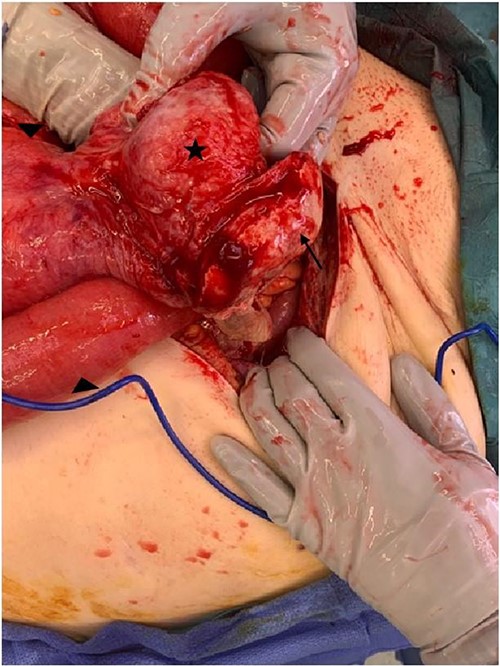 Intraoperative image demonstrating loop of small bowel (marked by triangle) extending into the perineal hernia sac (marked by star) with the vaginal vault mucosa attached to sac (marked by arrow).
