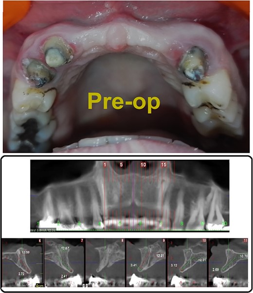 (A) Pre-operative photograph, (B) pre-operative CBCT.