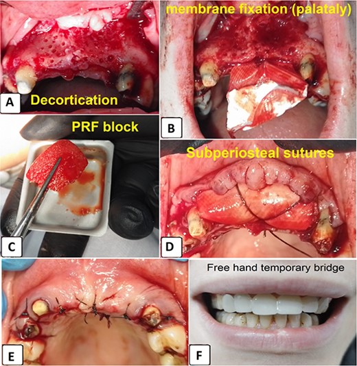 (A) Decortication, (B) collagen membrane fixation, (C) C-PRF Block, (D) collagen membrane fixation using resorbable sutures, (E) flap replacement and suturing, (F) temporary bridge placement.