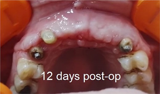 12 days postoperative.