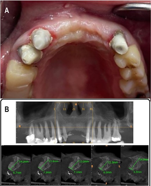 (A) 5 months postoperative photograph, (B) 5 months postoperative CBCT.