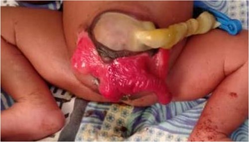 Illustration of exstrophy of the cecum between two exstrophied halves of the bladder and an imperforate anus.