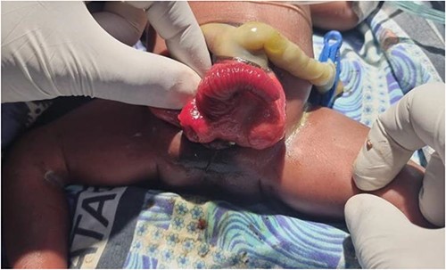 Illustration of cloacal exstrophy and the omphalocele.