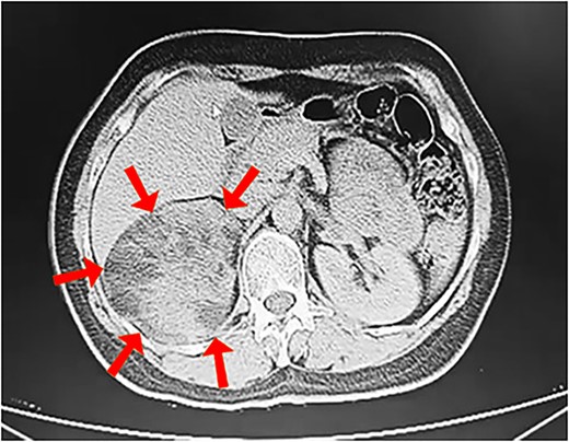 Contrast-enhanced CT scan showing a heterogeneous mass measuring 13 × 12 × 9.5 cm in the right adrenal gland (arrows).