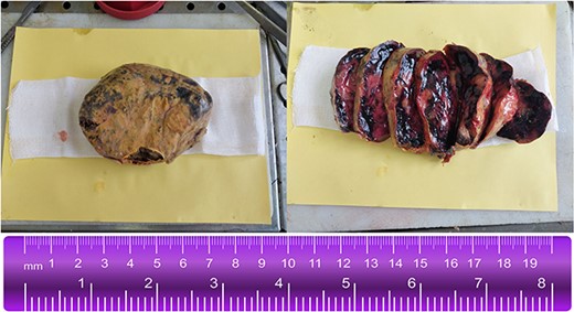 Gross examination of the right adrenal mass (44.5 g, 15 × 10.5 × 5 cm). Encapsulated, rubbery to cystic consistency with hemorrhage foci. Heterogeneous, yellow to black, gelatinous cut surface.
