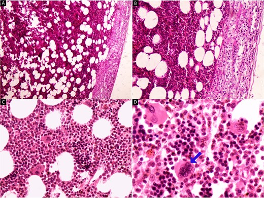 Hematoxylin and eosin-stained images (a–d) of the adrenal tumor. At low magnification (a, b), a mixture of mature adipose tissue with hematopoietic elements is evident, and the preserved adrenal tissue is observed in the upper right part of the tumor (40× and 100×). High-power magnification (c, d) reveals the presence of megakaryocytes (arrow) amidst myeloid and erythroid cells, along with hemosiderin deposits (200× and 400×).