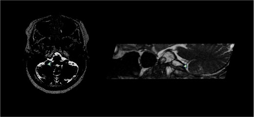 T2-weighted MRI with FIESTA sequence demonstrated right PICA compression of the right glossopharyngeal nerve entry zone demonstrating the axial and sagittal view. Arrow demonstrates location of neurovascular compression.