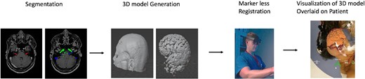 Overview of augmented reality system work flow. The process begins with segmentation of relevant anatomy followed by generation of a patient-specific 3D anatomical models. Using the headset, a surgeon registers the 3D model onto the patients’ head using a fiducial-less approach allowing for visualization of the 3D model overlaid onto the patients’ head.