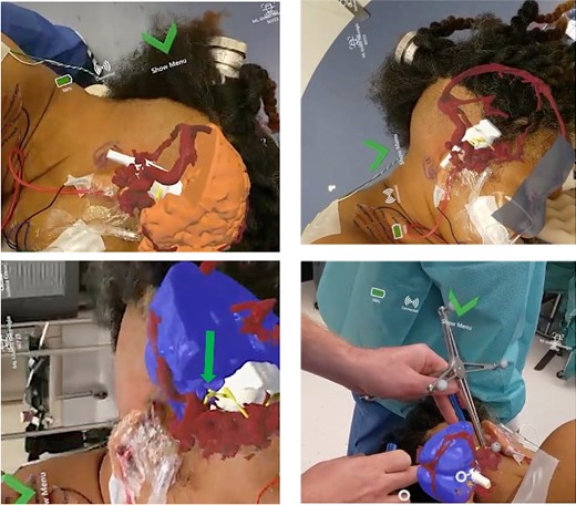 Representative views through the AR headset of 3D models overlaid onto the patient’s head from different perspectives. Brain (blue/orange), vasculature (red), cranial nerves (yellow), and brainstem (white).