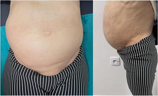 Real images of the substantial abdominal-pelvic swelling, both front and side views.