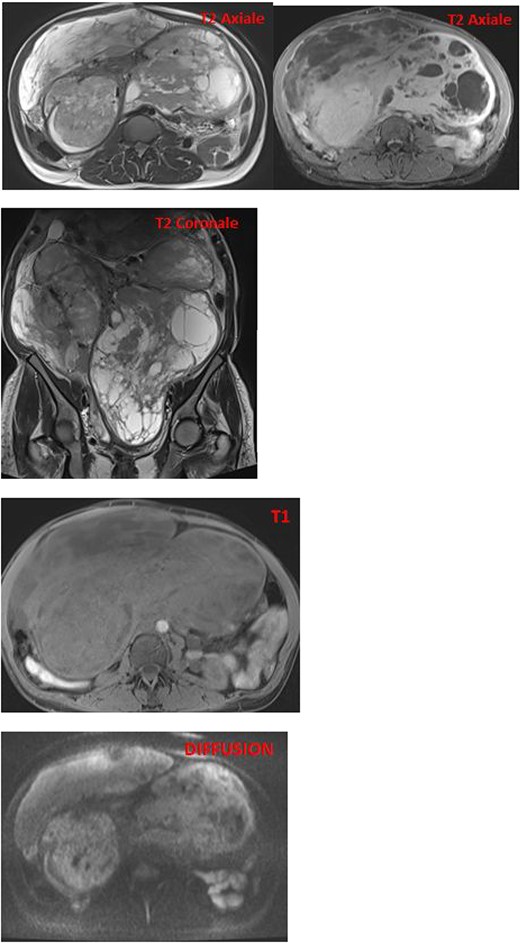 MRI images reveal an enlarged uterus with multiple myometrial formations exhibiting intermediate signal on T1 and T2, encompassing regions of hyperintensity on T2 and hypointensity on T1, enhanced homogeneously compared with the myometrium and without diffusion restriction, the most characteristic ones are classified as FIGO 6, FIGO 7, and FIGO 2–5, suggesting uterine leiomyomatosis with cystic degeneration.