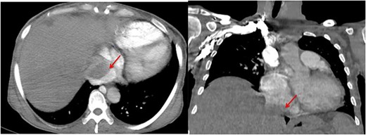 Angio-CT thoracic images reveal the presence of a mass in the inferior vena cava extending into the right atrium (arrow).