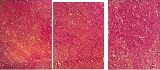 Pathological images of HE-stained slides with three levels of magnification: (a) ×200, (b) ×400, (c) ×1000; proliferation of spindle-shaped cells without cyto-nuclear atypia, very low mitotic activity, and negative tumor necrosis; the appearance suggests benignity.