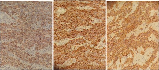 Anatomo-pathological images with immunohistochemical staining: smooth muscle actin antibody +, Desmin antibody +, Codexin antibody + suggestive of smooth muscle differentiation resembling myometrial cells.