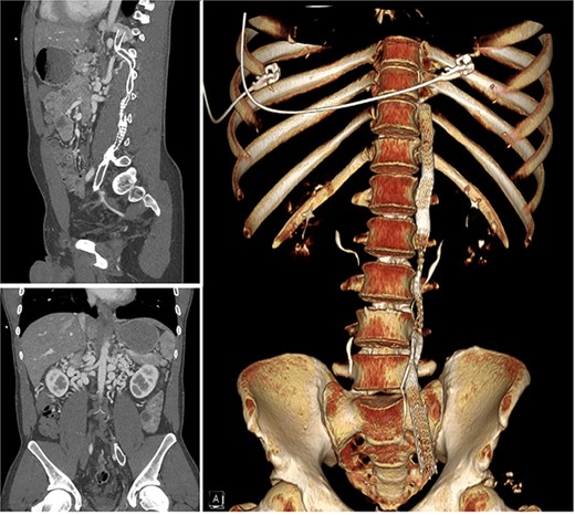 Computer tomography scan showing chronic occlusion of the infra-hepatic IVC and common iliac veins.