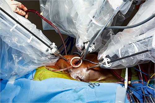 Intraoperative picture showing a 32 French bullet tip venous cannula placement in the right atrium via the right atrial appendage.