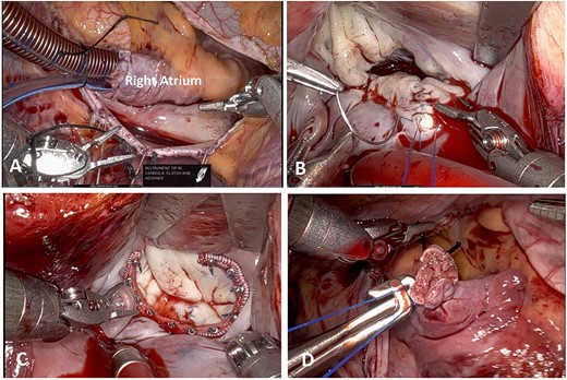 (A) Atrial Venous Cannulation. (B) Mitral Valve Repair. (C) Ring Annuloplasty. (D) Atrial Cannulation Site.
