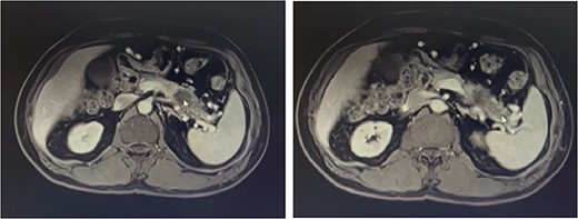 Metastatic masses can be seen in the pancreatic tissue on the CT-Scan (transverse/axial view)