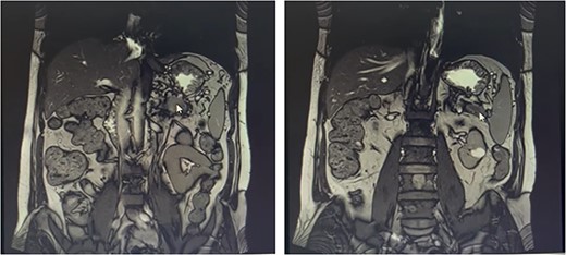 Metastatic masses can be seen in the pancreatic tissue on the CT-Scan (coronal view)