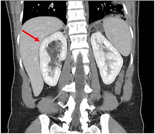 Preoperative CT showing renal AML.