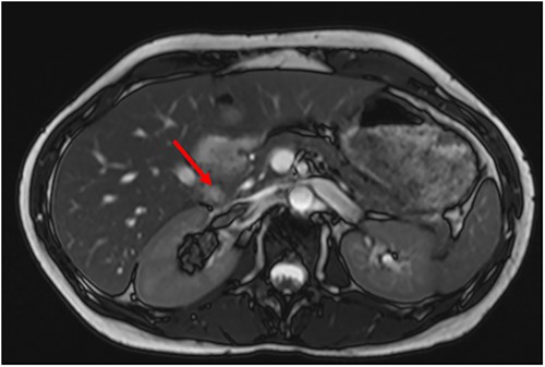 Preoperative MRI with tumor thrombus extension into right renal vein.