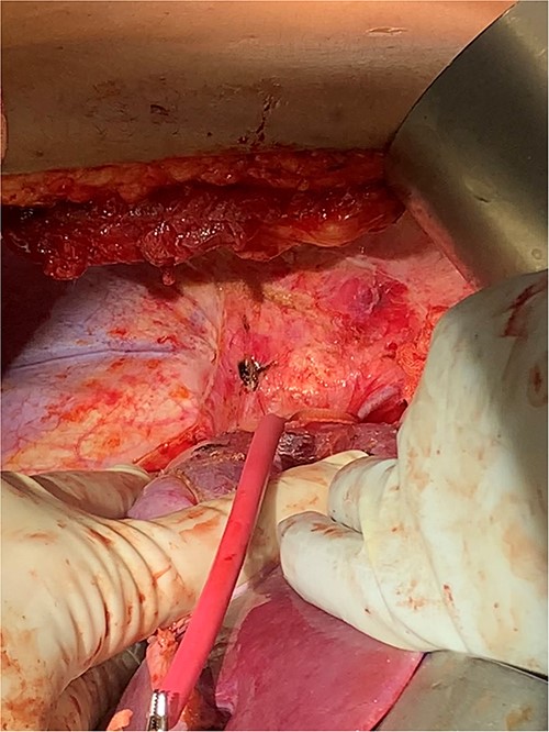 Suprahepatic IVC control.