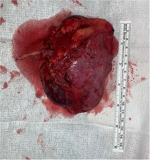 Specimen with thrombus extension into the right renal vein.