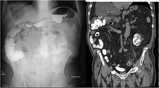 X-ray post barium swallow demonstrating early contrast opacification of the ascending colon with coronal slice of CT confirming the presence of a fistula between the duodenum and ascending colon below the hepatic flexure.