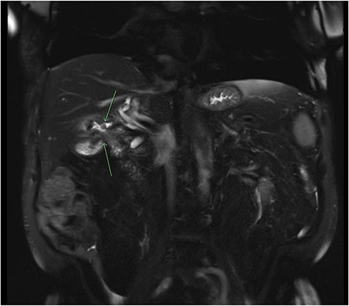 Coronal slice of a magnetic resonance cholangiopancreatography (MRCP) with IV gadolinium demonstrating an abnormal fistulous connection between the contracted small calibre gallbladder and the colon just below the hepatic flexure; there is evidence of a second fistulous tract between the gallbladder and the duodenum.