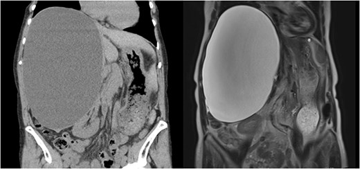 A 13 × 17 × 24 cm hepatic cyst in the right lobe is observed in both CT and MRI.
