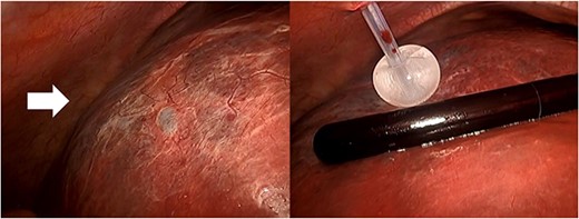 The hepatic cyst in the right lobe (arrow) and the puncture with a double-balloon catheter to aspirate the cystic fluid.