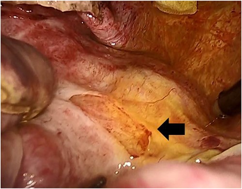 The bile leaked from the inner area of the cyst after deroofing (arrow).