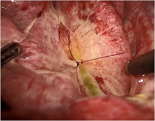 The orifice is closed laparoscopically with a monofilament absorbable suture.