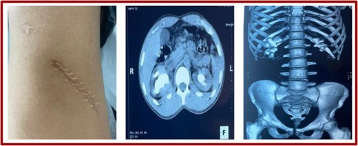 Lumbotomy scar and scans (coronal sections and reconstruction).