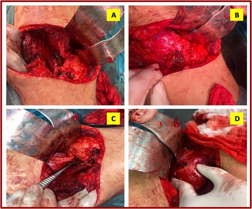 Intraoperative images showing exploratory finding.