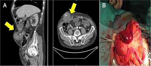(A) Computed tomography shows the small intestinal herniation from the space between right ureter and trasversalis fascia; the arrows show hernial orifice; (B) surgeons observed engorgement of the bowel loops.