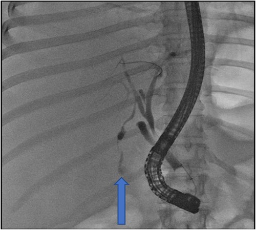 Fluoroscopy image indicating bile leak from type 2 duct of Luschka.