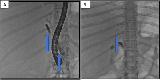 (A) First fluoroscopic image shows evidence of no bile leak from cystic duct stump as indicated by the arrows; (B) second fluoroscopic image shows a stent placed into the RHD.