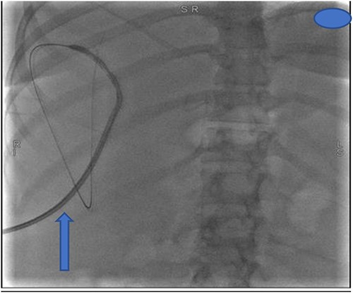 Insertion of percutaneous catheter drainage for drainage of biloma.