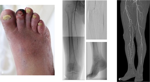 The preoperative clinical picture of case 1; (a) gangrene of the second digit with infection; (b) preoperative angiography; the GLASS stage was II (TAP: posterior tibial artery, FP2, IP2); (c) postoperative computed tomography; superficial femoral artery-posterior tibial artery bypass with a great saphenous vein was performed.