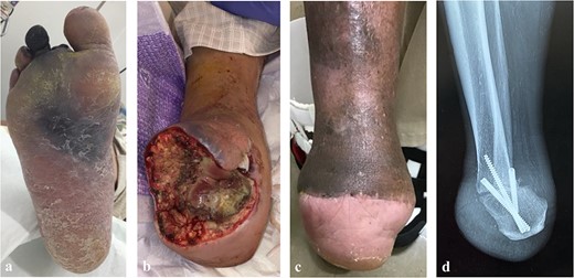 The postoperative clinical picture of case 1; (a) the infection spread to the third, fourth digits, and plantar side; (b) the clinical picture of after transection at the Chopart joint; (c) the clinical picture after Pirogoff amputation; (d) lateral radiography after Pirogoff amputation.