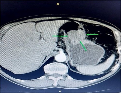Contrast-enhanced abdominal computerized tomography. The axial section presents a tumor mass measuring 55*85 mm in diameter.