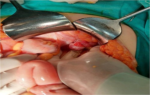 Supraumbilical median laparotomy.