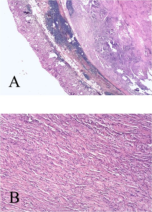 Spindle cell neoplasm arranged in interwoven connective tissue separated by a myxoid or hyalinized stroma - HeEo × 5 (A), HeEo × 40 (B).