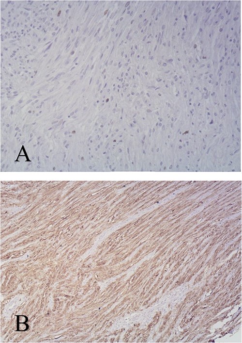Immunohistochemical staining of biopsy specimen Ki67 × 100 (A), S100 protein×100 (B).