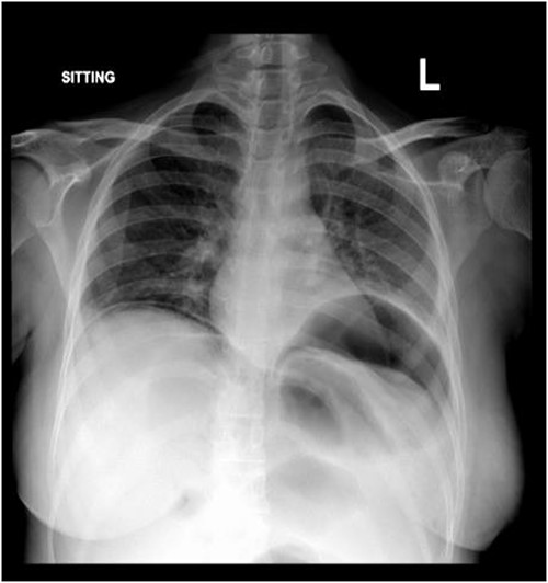 Chest X-ray.