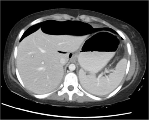 CT abdomen with oral and IV contrast.