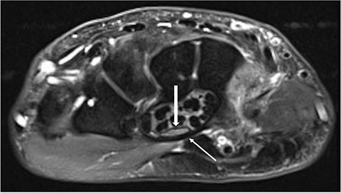 Axial MRI slice showing the carpal tunnel. A thickened transverse carpal ligament (thin arrow) with a clear indentation of the median nerve (thick arrow) is shown.
