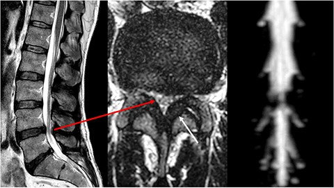 MRI of the lumbar spine. Left sagittal slice with a stenosis of vertebral bodies L4/L5, in the axial slice (centre) corresponding stenosis (long arrow) with clear thickening of the ligamenta flava (short arrow). On the right, there is a clear cerebrospinal fluid blockage in the area of the stenosis.