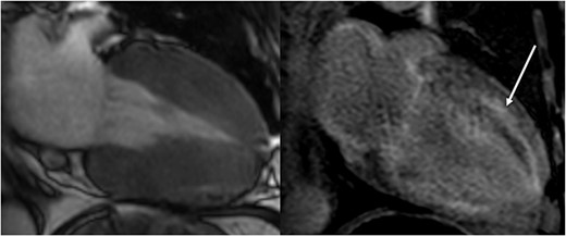 Cardiac MRI (2-chamber view) shows marked hypertrophy of the ventricular musculature on the left in the onset of systole. On the right, there is a clear late enhancement after administration of gadolinium diethylenetriaminepentaacetic acid (DTPA) (arrow).